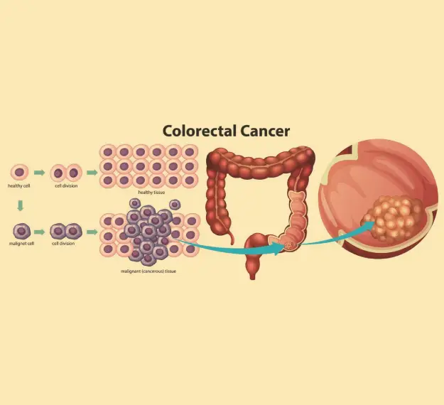 Gastrointestinal Oncology Care