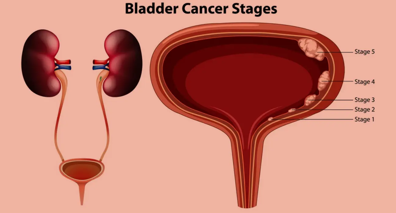 Best & Affordable Kidney & Urinary Bladder Cancer Treatment in Haryana