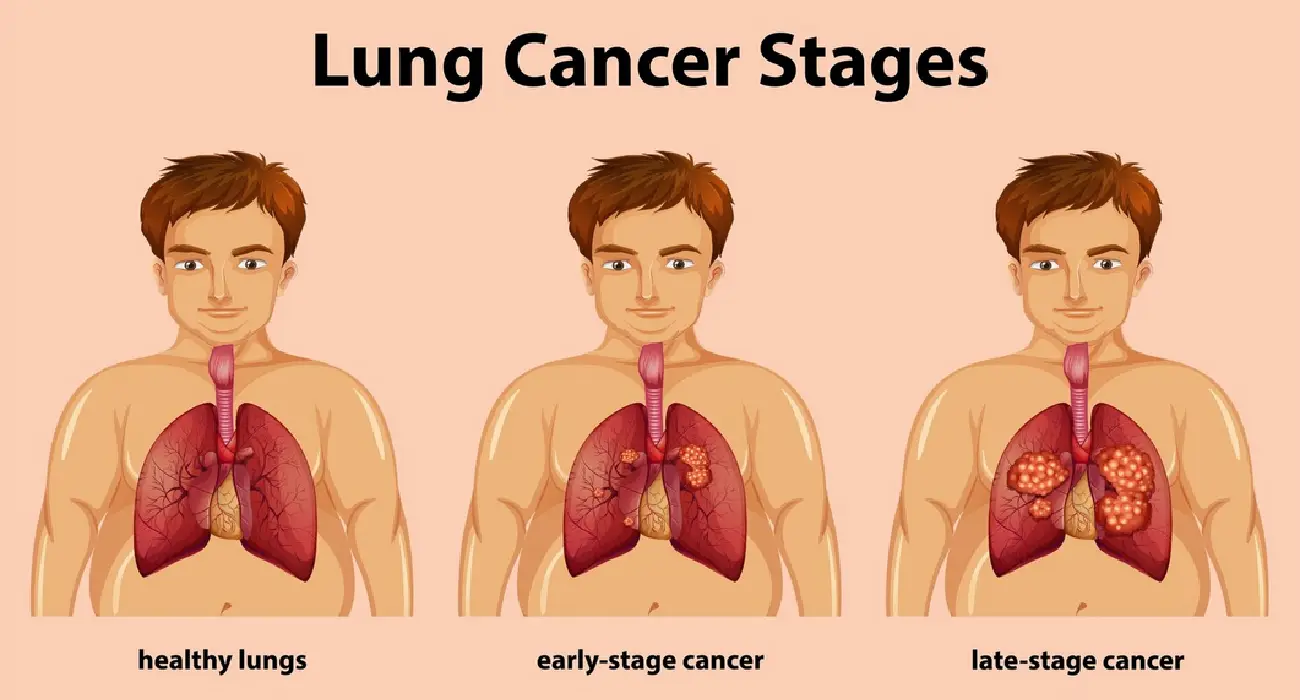 Affordable Lung Cancer Treatment by Dr Keshav Garg, Haryana