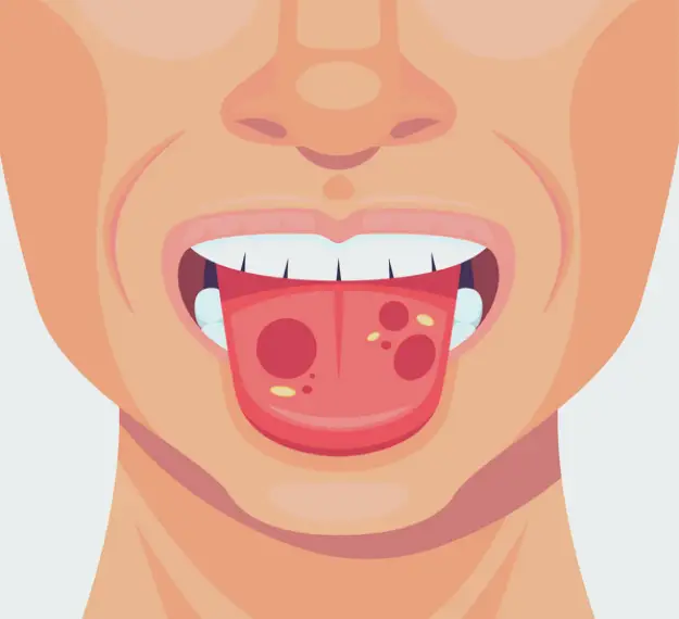 Oral Tongue Tumor Specialist in Rewari, Dr Keshav Garg